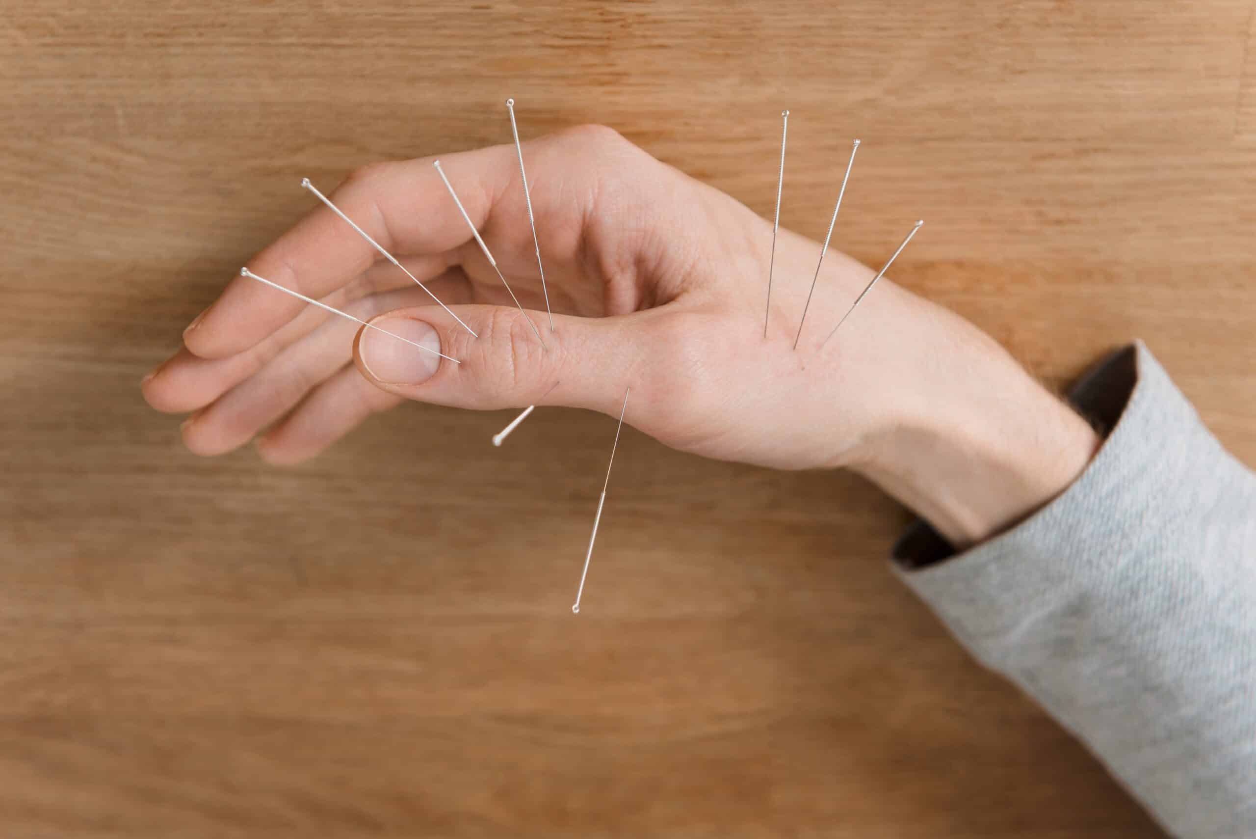 Anatomical Acupuncture Grande Prairie | Physiotherapy